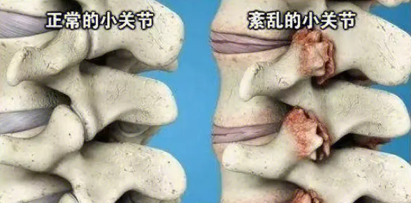 邵陽創(chuàng)傷骨科,邵陽風濕病區(qū),邵陽骨質增生,邵陽關節(jié)病區(qū),邵陽頸椎病區(qū)