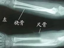 邵陽創(chuàng)傷骨科,邵陽風濕病區(qū),邵陽骨質增生,邵陽關節(jié)病區(qū),邵陽頸椎病區(qū)